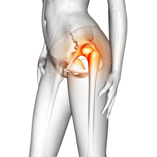 Avascular Necrosis illustration