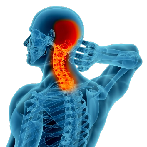 Cervicogenic Headache illustration