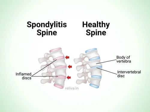 Spondylitis illustration