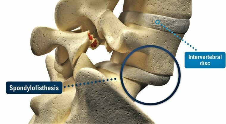 Spondylolisthesis illustration