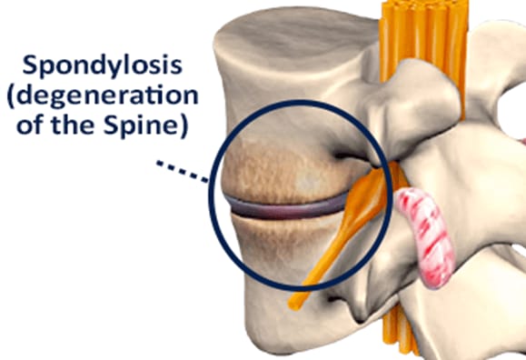 Spondylosis