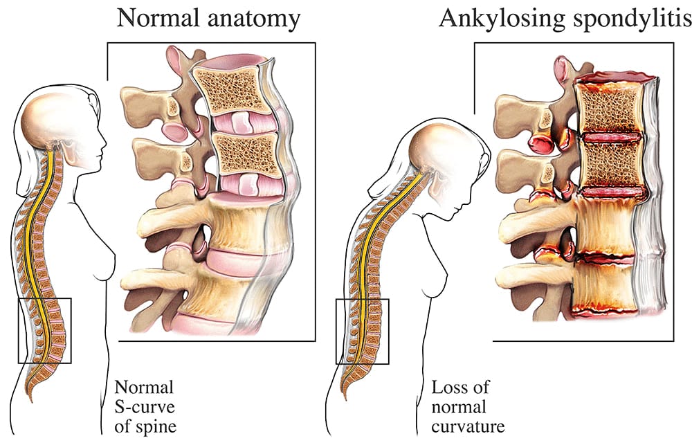 Ankylosing Spondylitis illustration