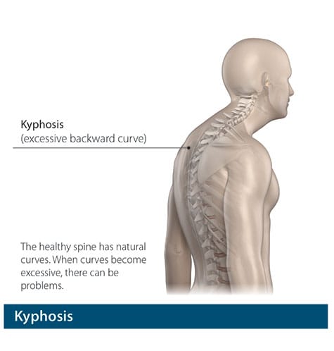 Kyphosis illustration