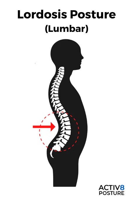 Lordosis illustration