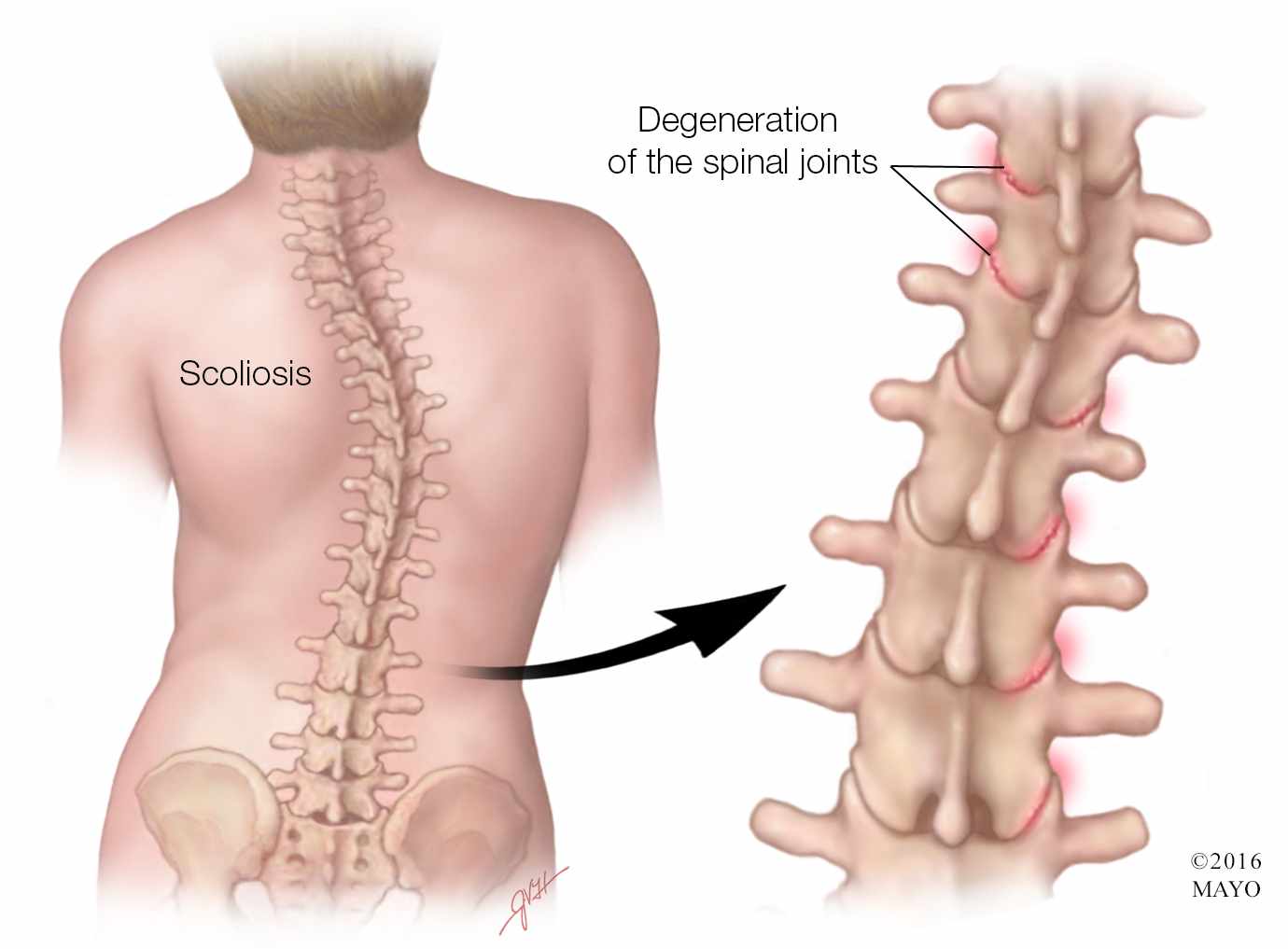 Scoliosis illustration