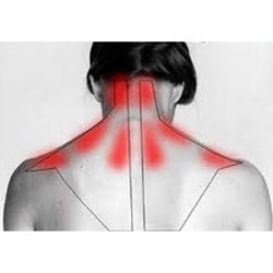 Trapezitis illustration